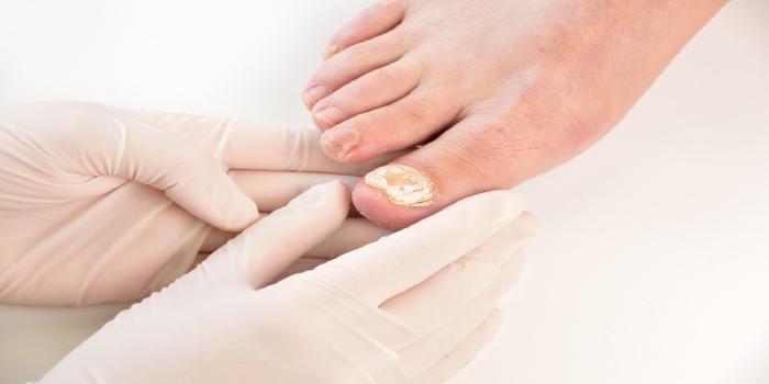 Big Toe Nail Fungus